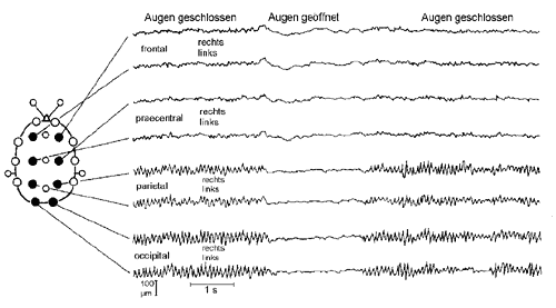 Typisches Muster des EEG